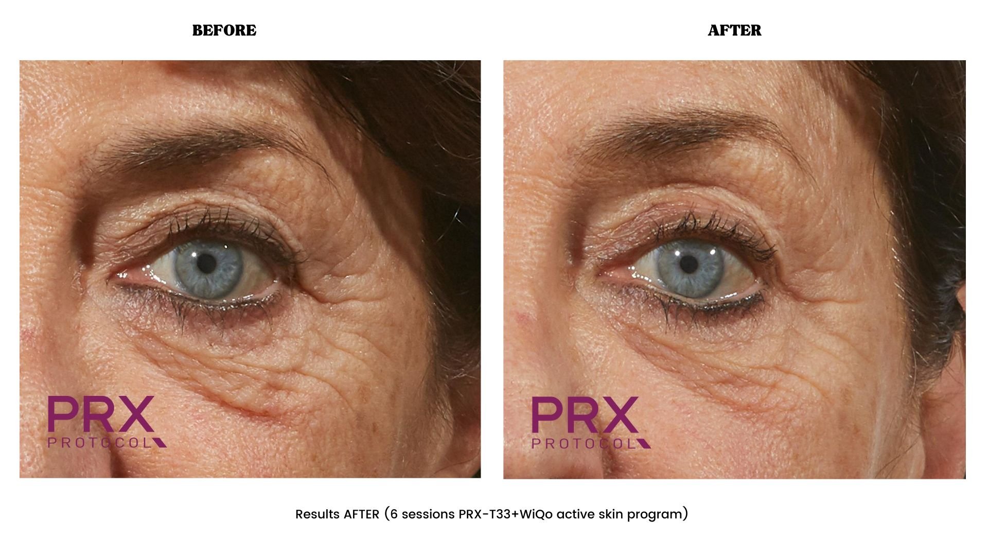 Eyes before and after PRX-T33