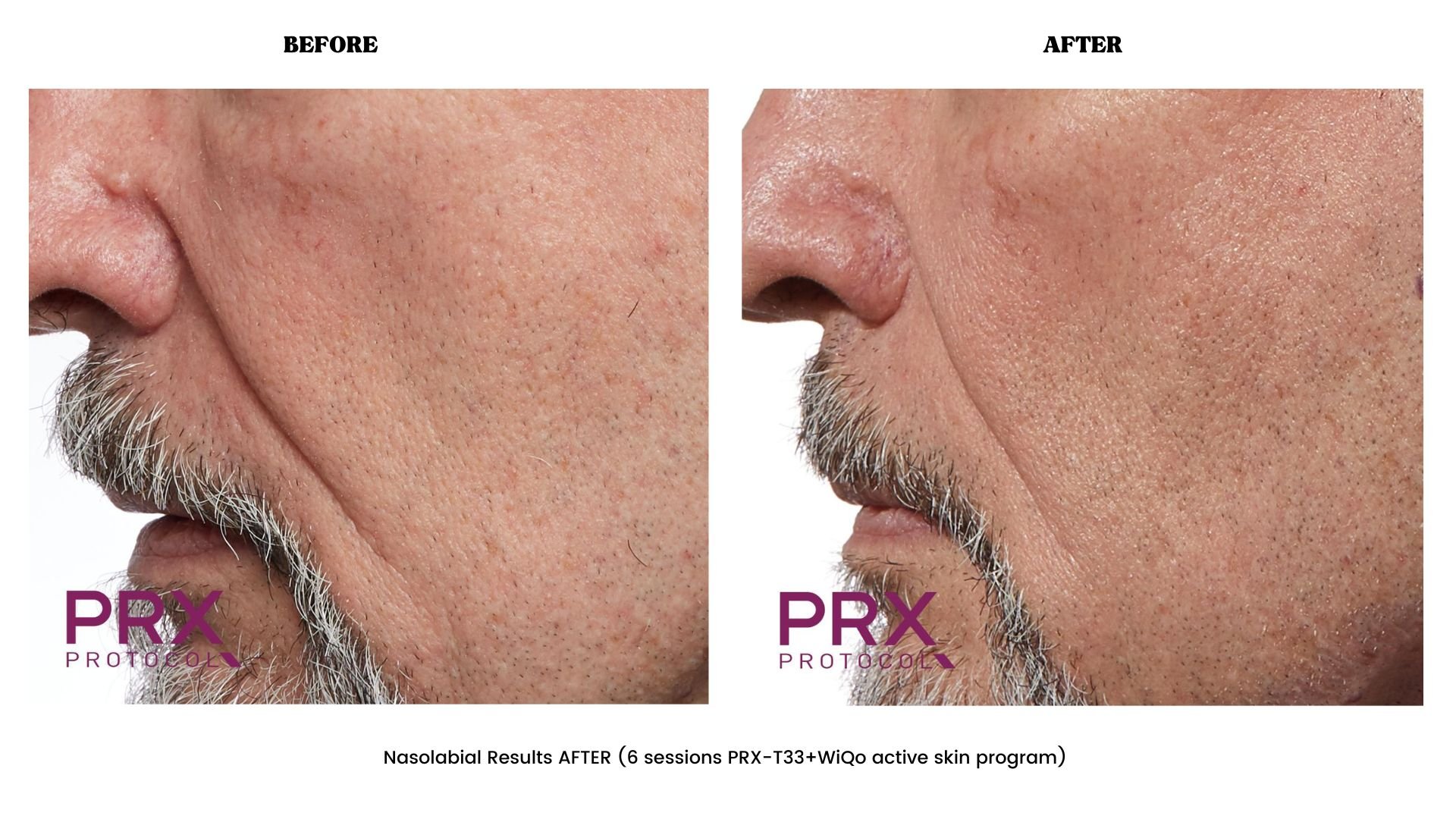 Nasolabial before and after PRX-T33