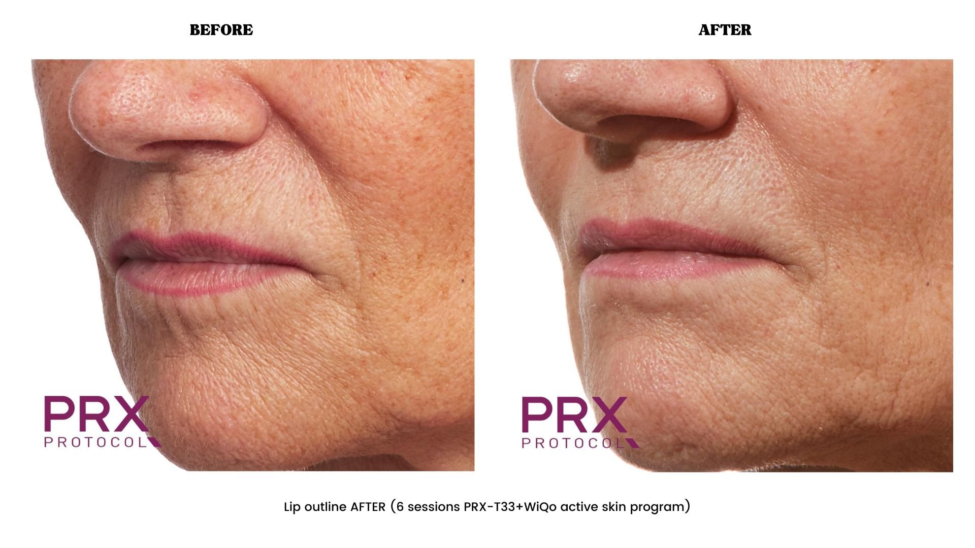 Lip outline before and after PRX-T33