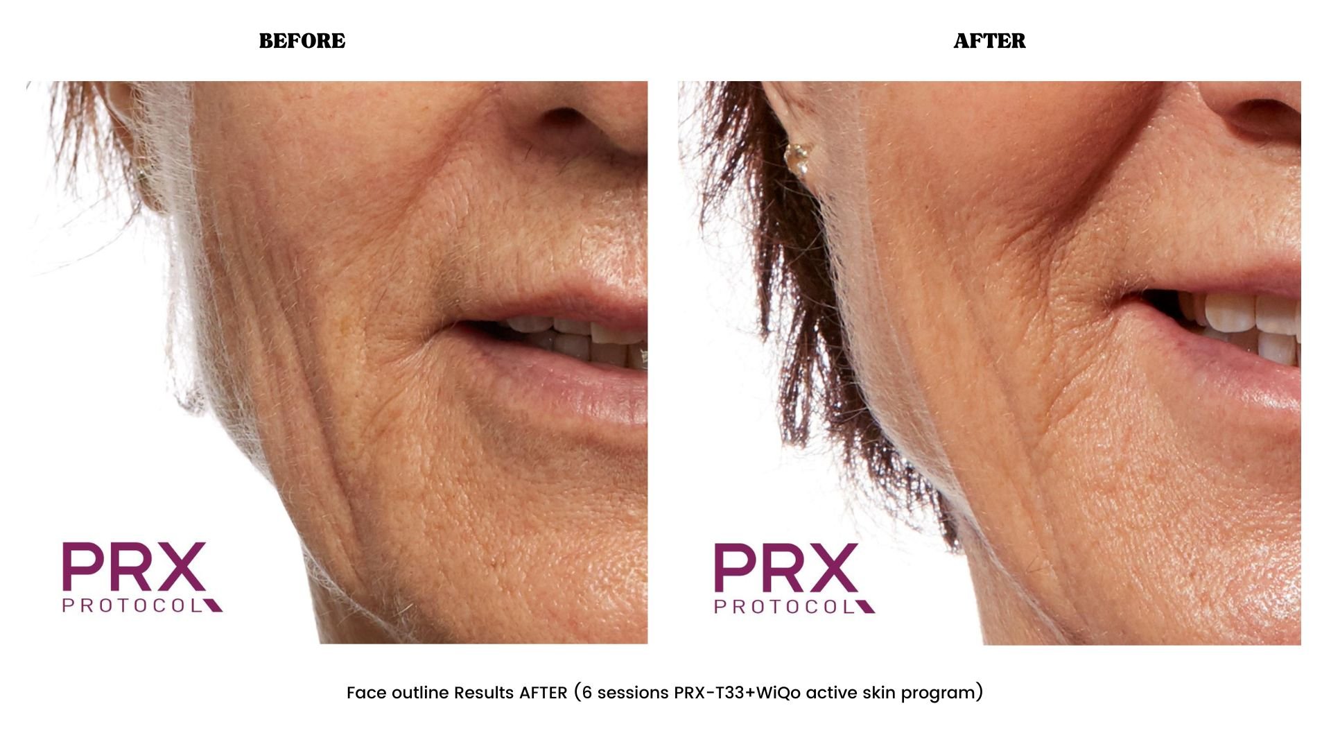 Face outline before and after PRX-T33