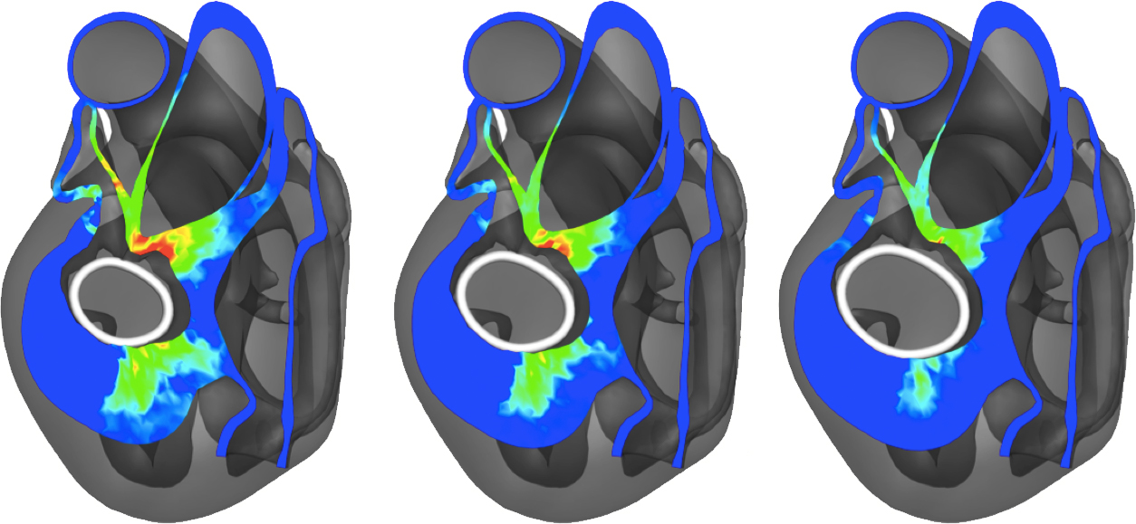 A virtual annuloplasty ring sizing tool. Shown are myocardial deformations in response to the implantation of three different ring sizes.