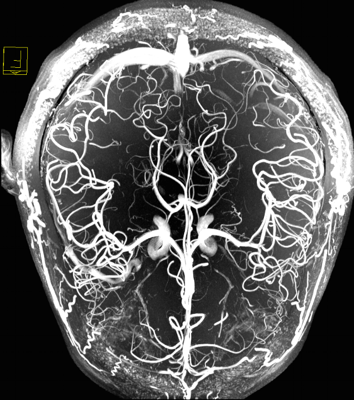brain vessels.png