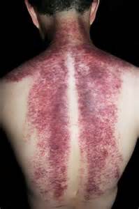 This is an example of overuse with the IASTM application!