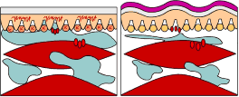 Notice in the image to the left the increased subcutaneous space with the rippling of the skin caused by K-tape.