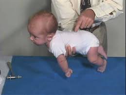 Above is an example of the Galant reflex where the child should side bend to the side of stimulus when stroked. this reflex should be gone shortly after 4 months of age.