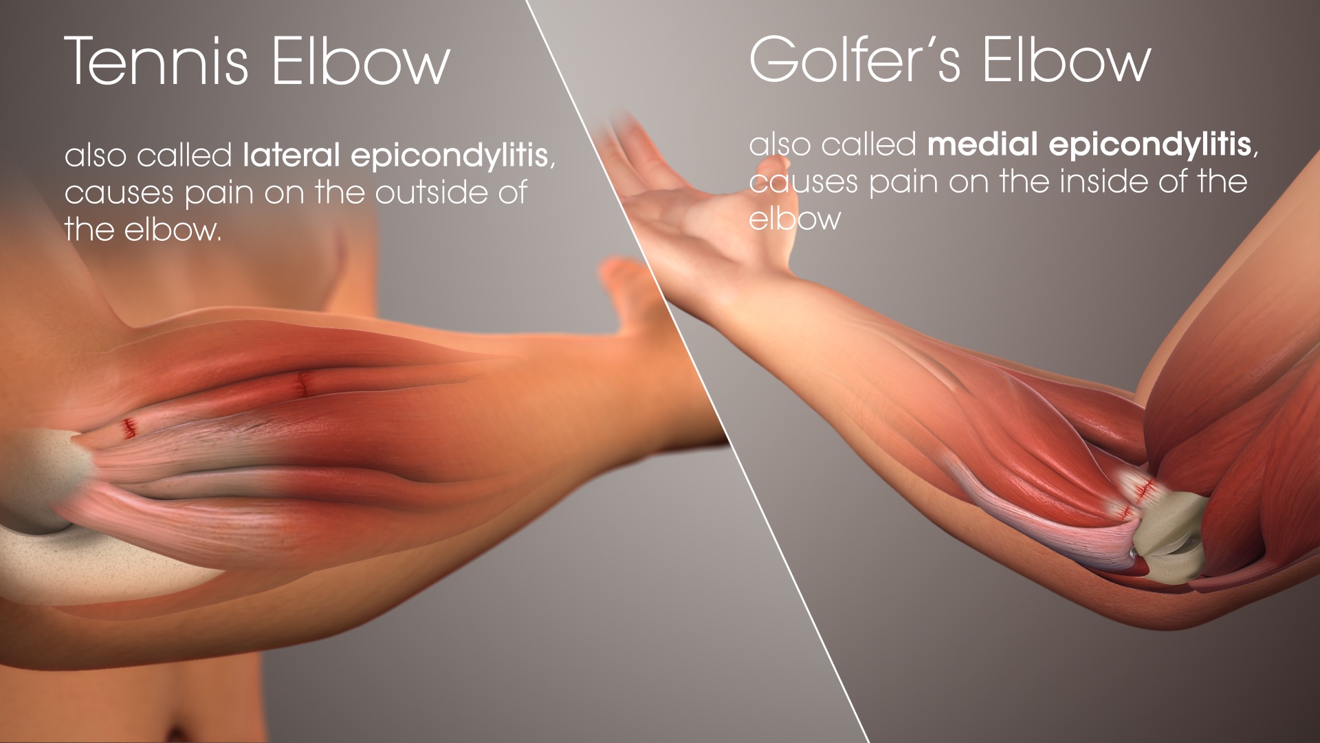 The inflammation is in the periosteum of the bone due to constant pull from the muscles/tendons from wrist extension.