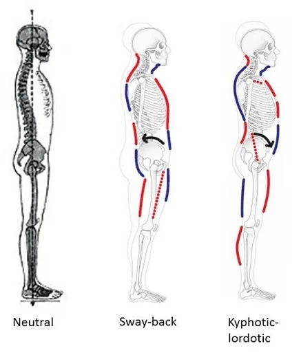 The image on the left, correct posture, has relatively no curves on the surface but has plenty of curve in the spine.