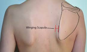 With proper muscle balance the shoulder lay flat against the ribs.