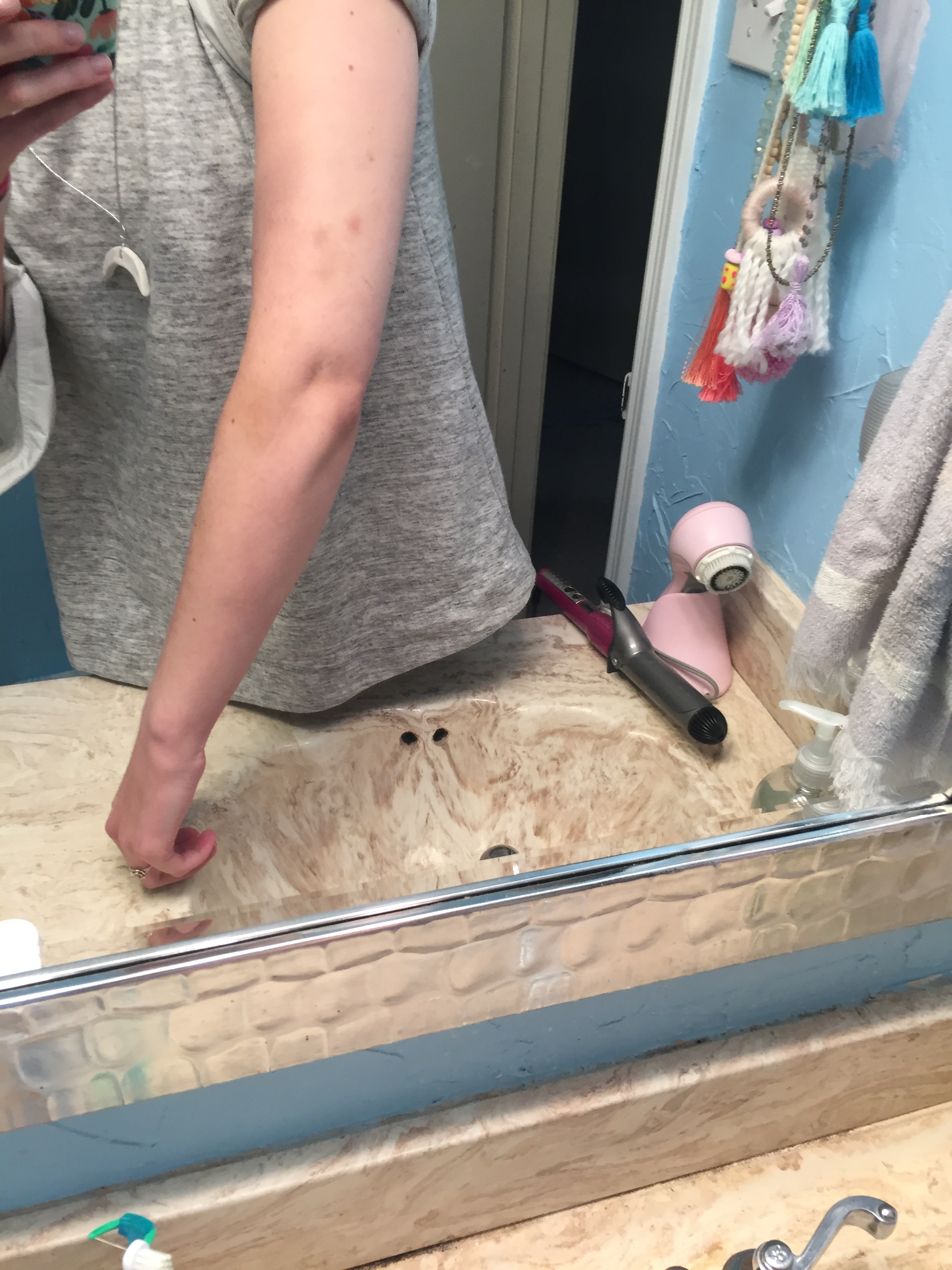 More tricep bruising.