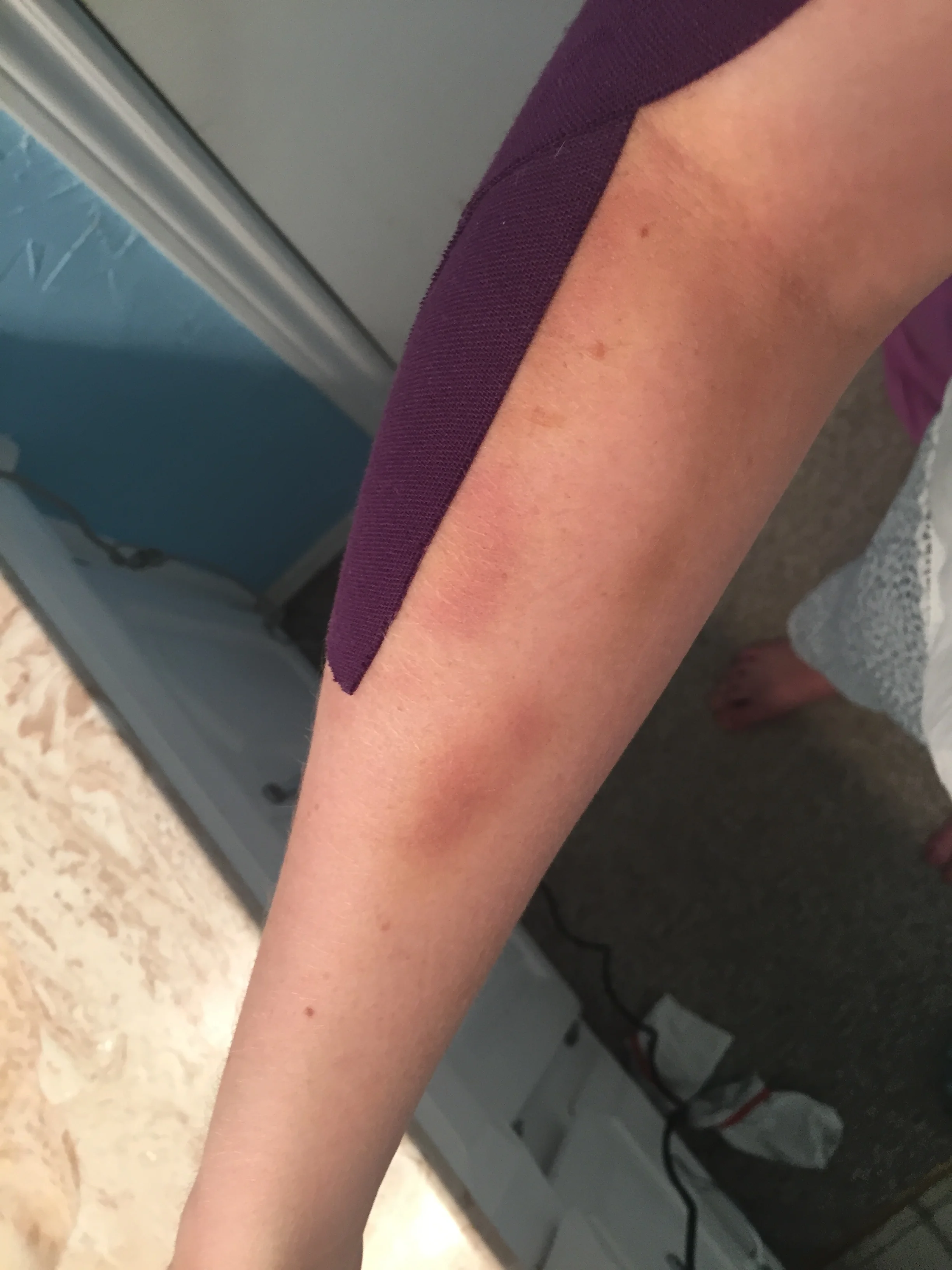 More bruises and purple tape.