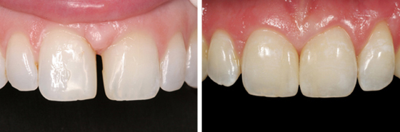 Partial Veneers