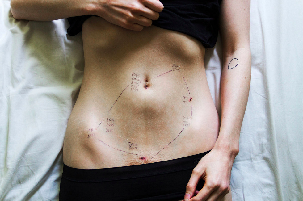 Endometriosis by Georgie Wileman