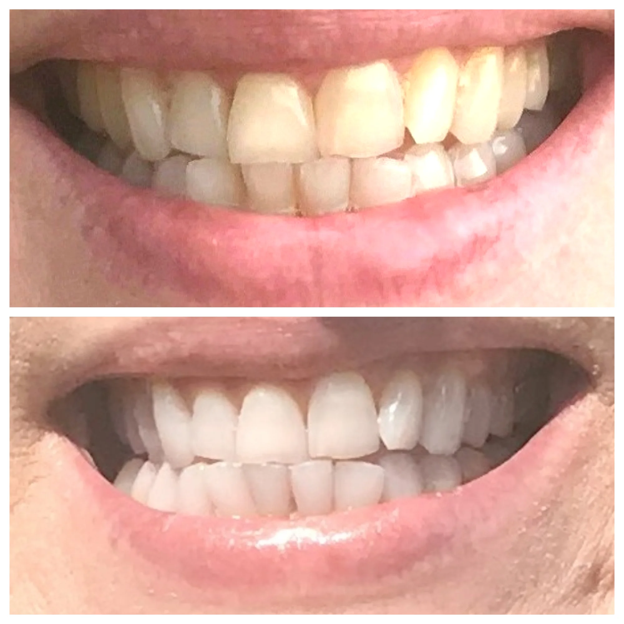 Before and after using Smile Brilliant Tooth Whitening System.