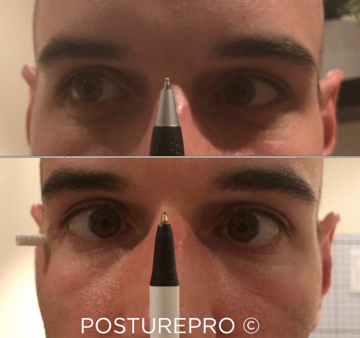 Eye convergence: Before and After.