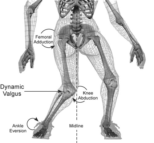 knee valgus 2.png