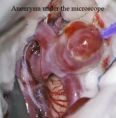 aneurysm-MCA-exposure.png