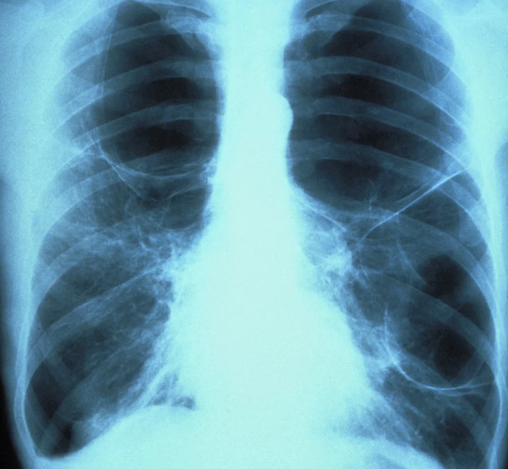  Needleman's Lung Spiders