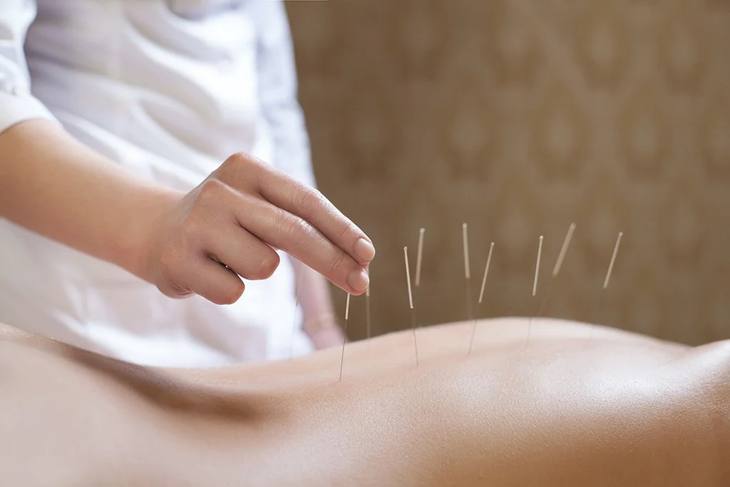 Acupuncture on back