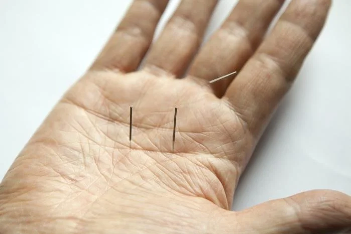 Acupuncture on hand