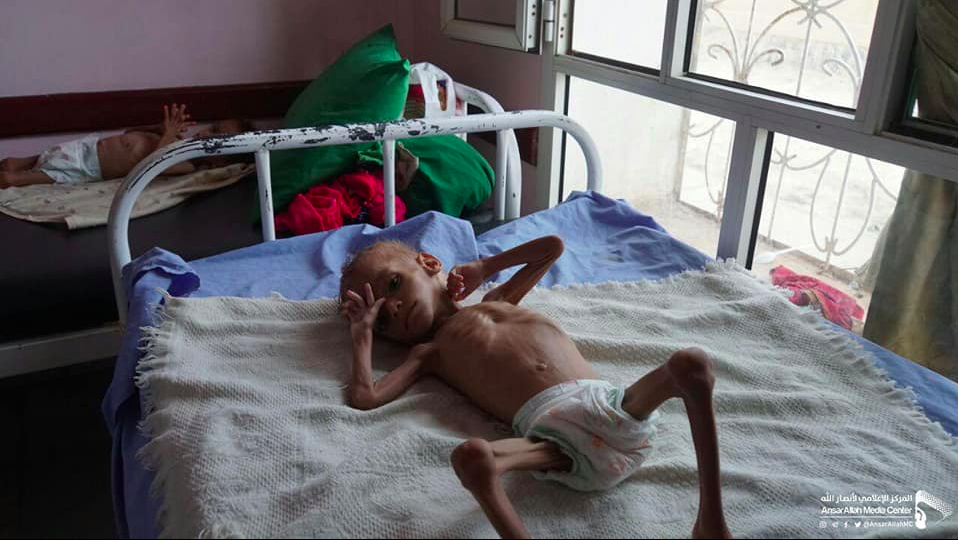 Jemen: Razmesarjeni in izstradani otroci