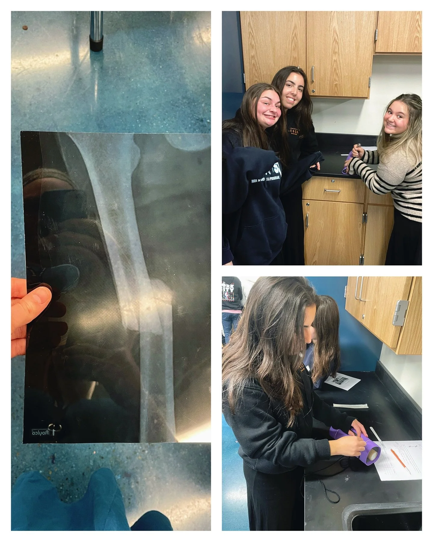 How do you fix a broken femur? Sulam students in Berman anatomy and physiology simulated stabilizing a fracture. 

#inclusion #jewisheducation #sulam #community