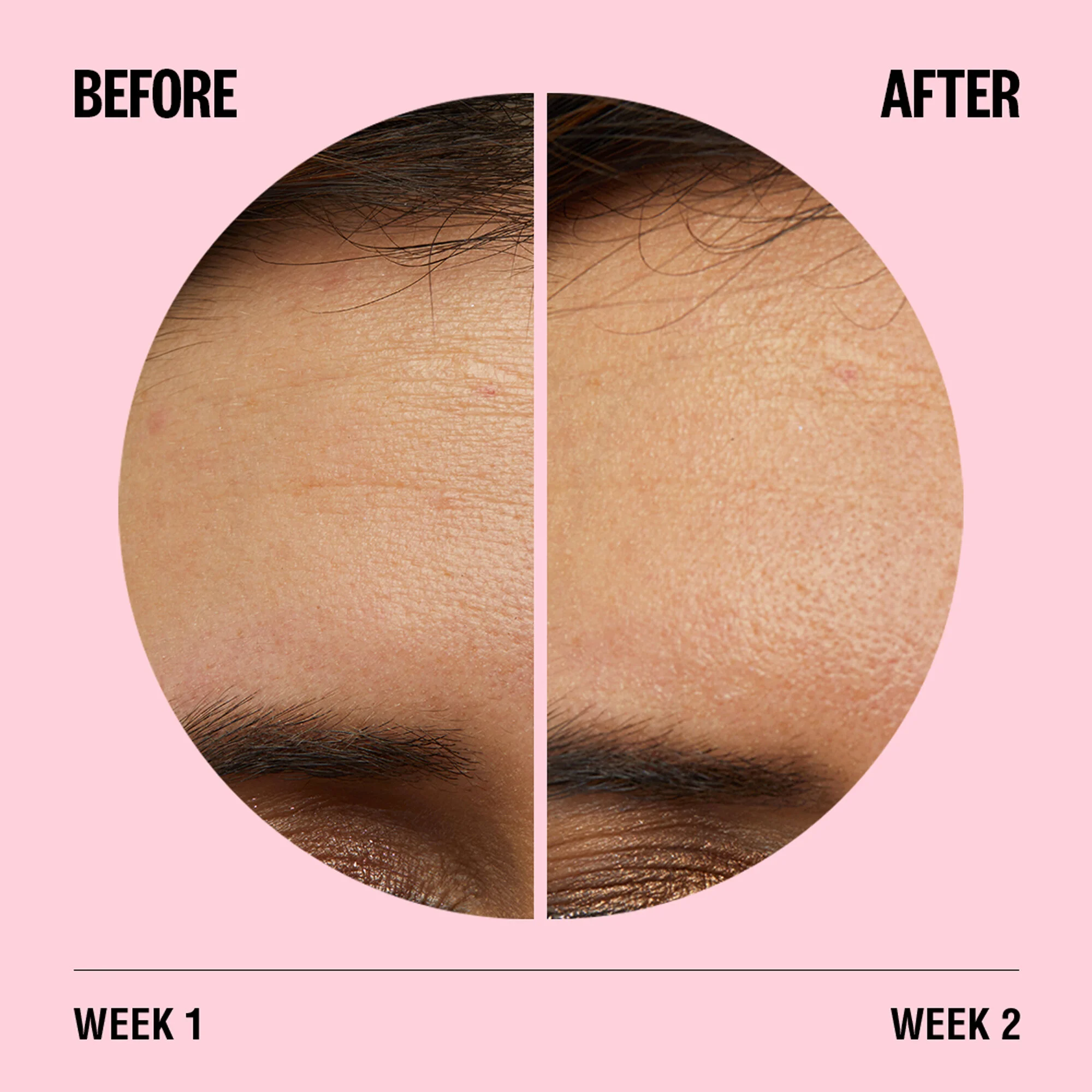 Before_after_forehead.jpg