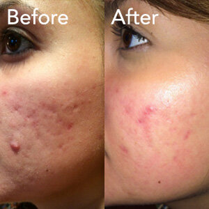 microneedling-acne-treatment-example-herb-and-ohm.jpg