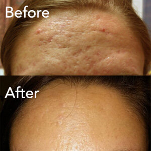 microneedling-acne-treatment-example-herb-and1-ohm.jpg