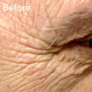 microneedling-eye-treatment-before-example-herb-and-ohm.jpg