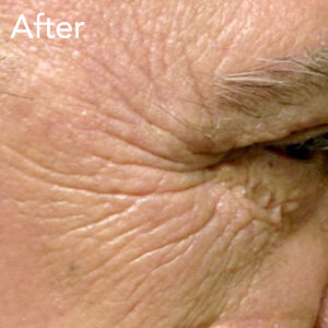 microneedling-eye-treatment-after-example-herb-and-ohm.jpg