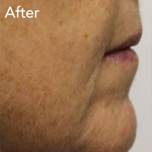 microneedling-mouth-fold-treatment-after-example-herb-and-ohm.jpg