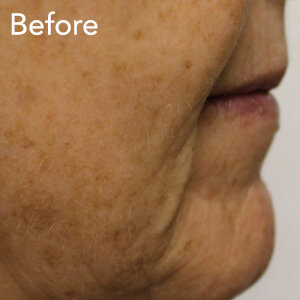 microneedling-mouth-fold-treatment-before-example-herb-and-ohm.jpg