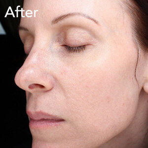 microneedling-face-treatment-after-example-herb-and-ohm.jpg