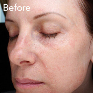 microneedling-face-treatment-before-example-herb-and-ohm.jpg