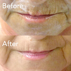 microneedling-lip-line-treatment-example-herb-and-ohm.jpg