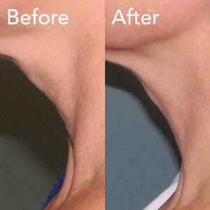 microneedling-neck-treatment-before-and-after-herb-and-ohm.jpg