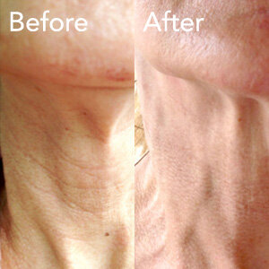 microneedling-neck-treatment-before-and-after-her1b-and-ohm.jpg