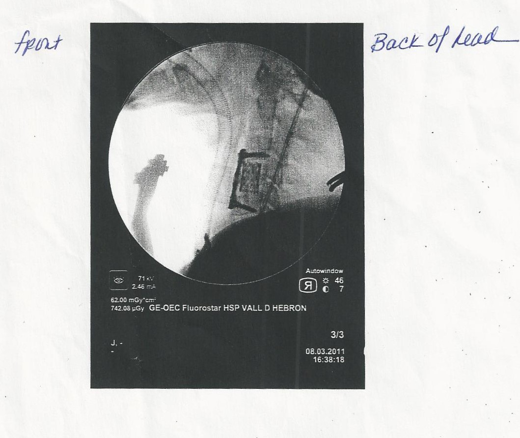 First X-Ray after the surgery