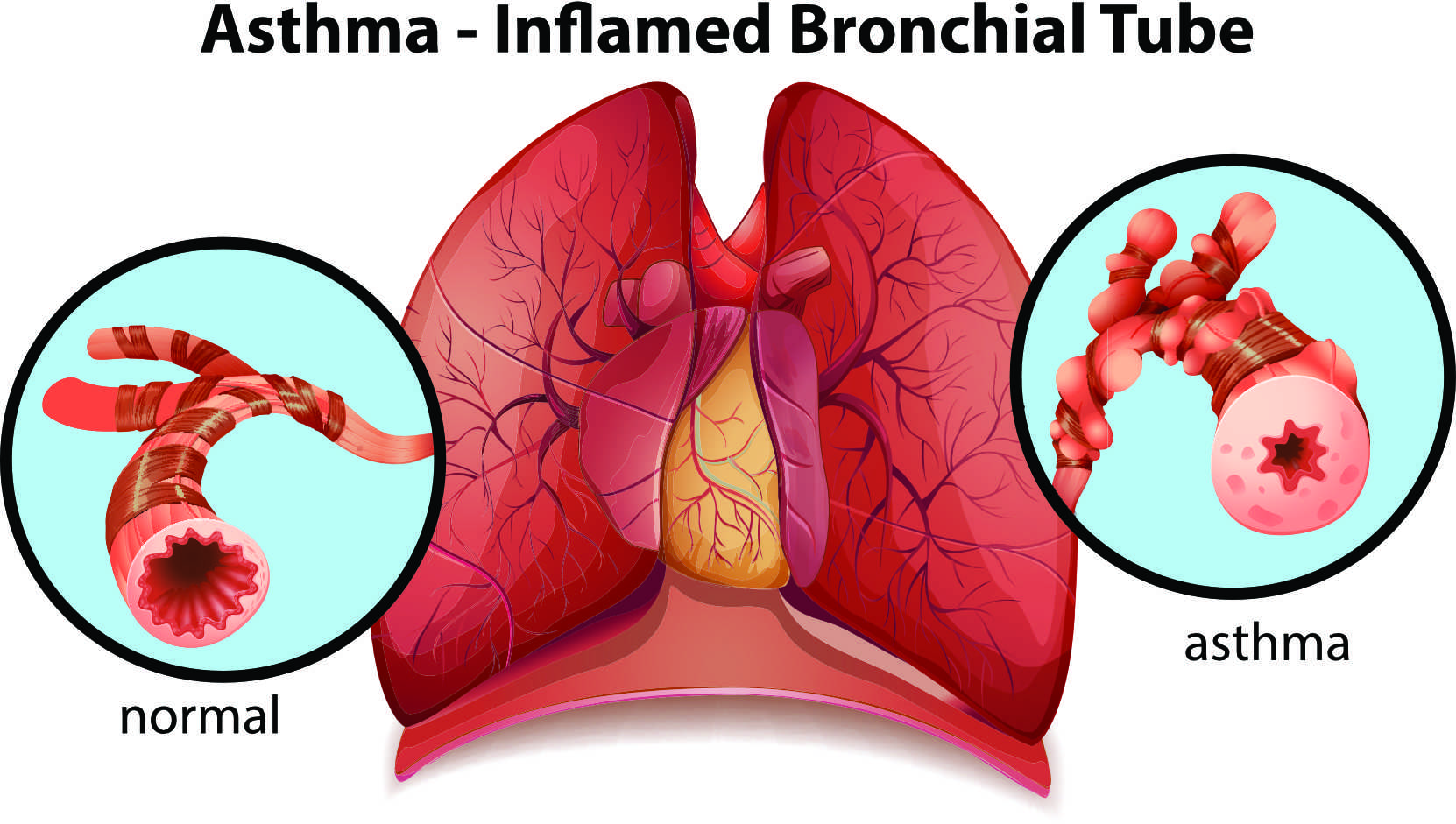 AdobeStock_74005512 asthma.jpg