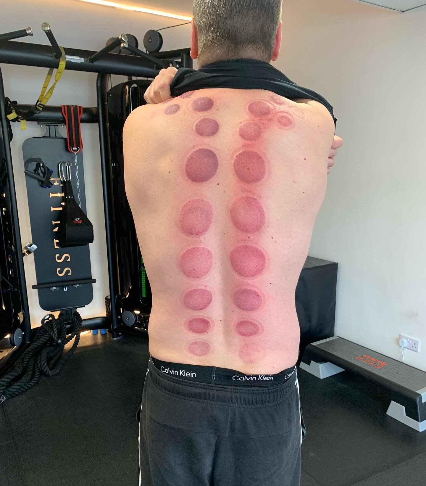 Ever tried Cupping? 😱
We now have appointments available every Friday. 
Deep Tissue, Sports &amp; Greco Roman Massage also available 
#massage #cupping #deeptissuemassage #massagetherapy #personaltraining #gym #results #bramhall #cheadlehulme #wilms