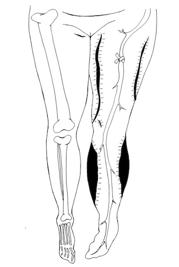  Fasciotomy, 2016 