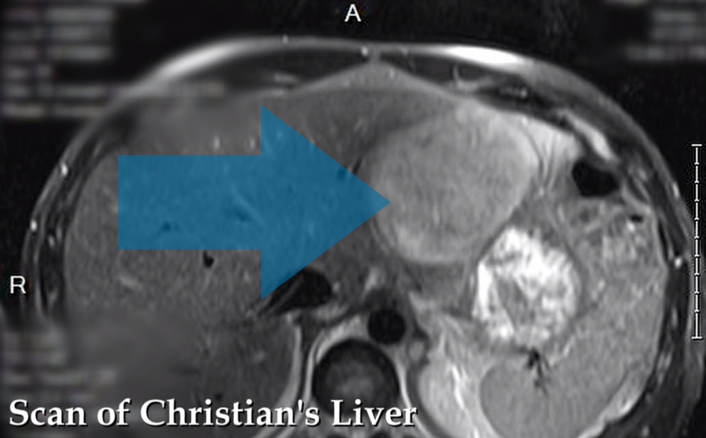"This was the largest liver abscess I have ever seen in my career," said Dr. Blass, Infectious Disease, Emory St. Joesph's Hospital.