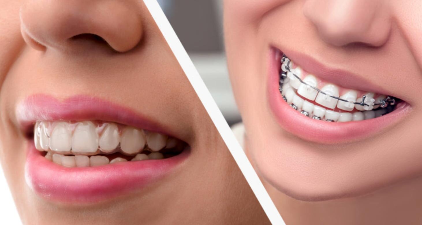 Invisalign Braces