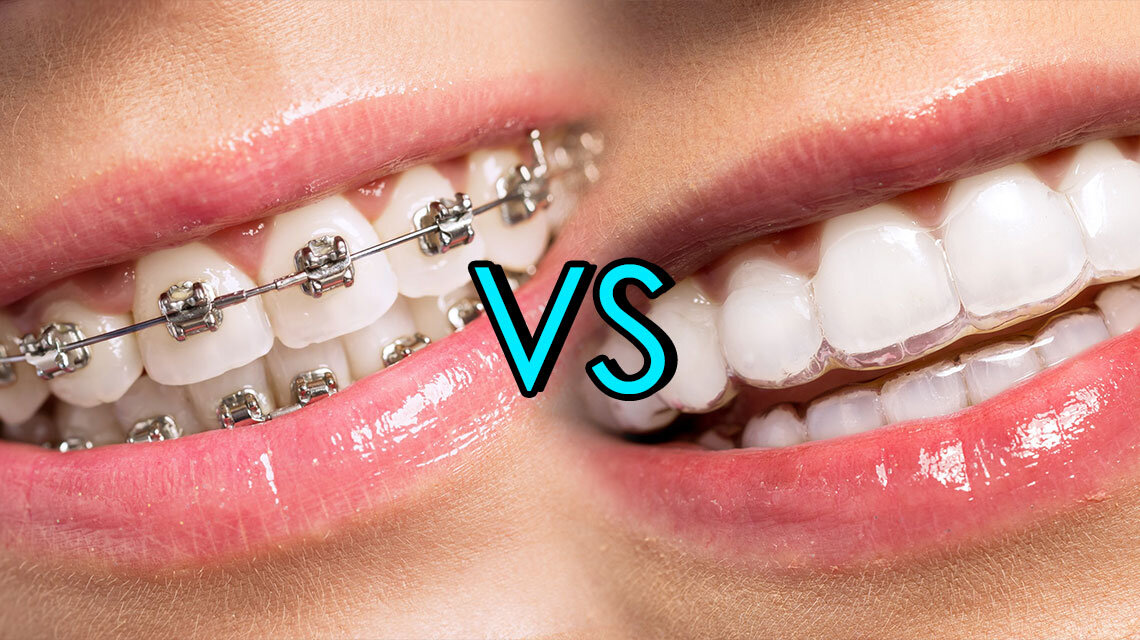 Conventional Dental Braces vs Invisalign — Valley Creek Dental Care