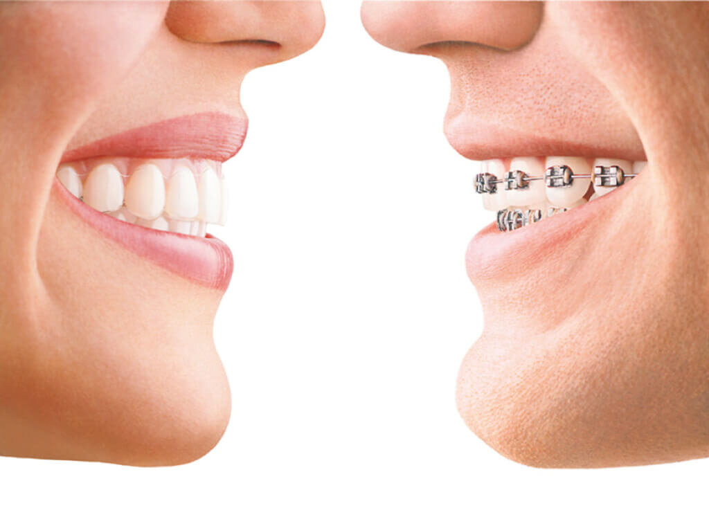 Kiss invisalign? with can you someone 