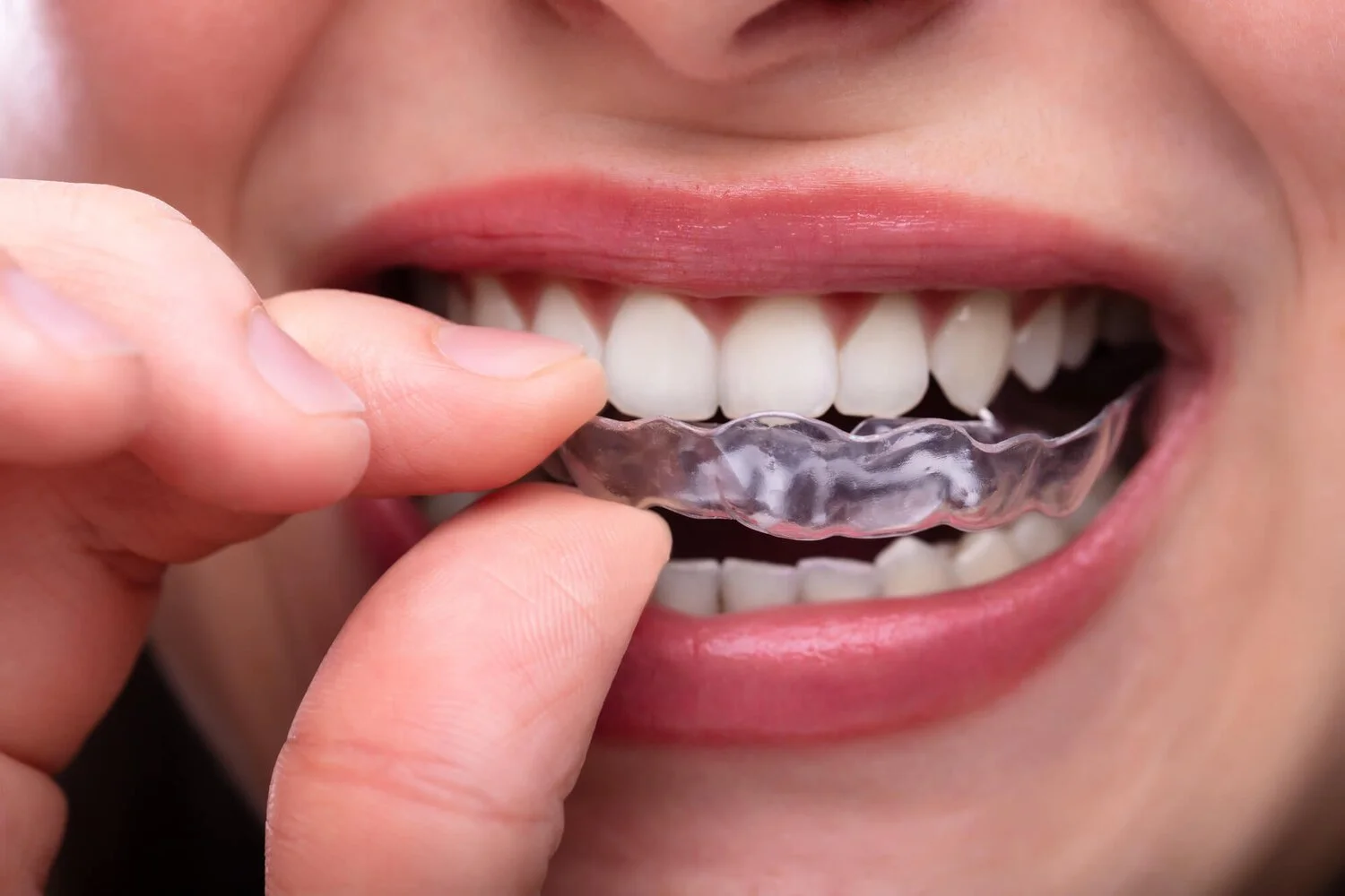 How and Why Invisalign Treatment is Better Than Metal Braces? 