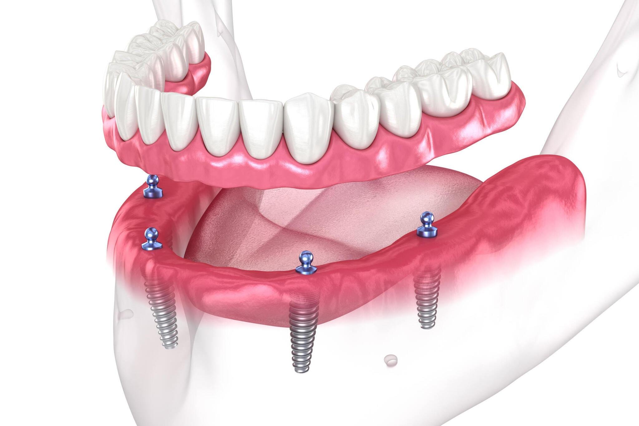 all on four dental implants — BLOG — Valley Creek Dental Care