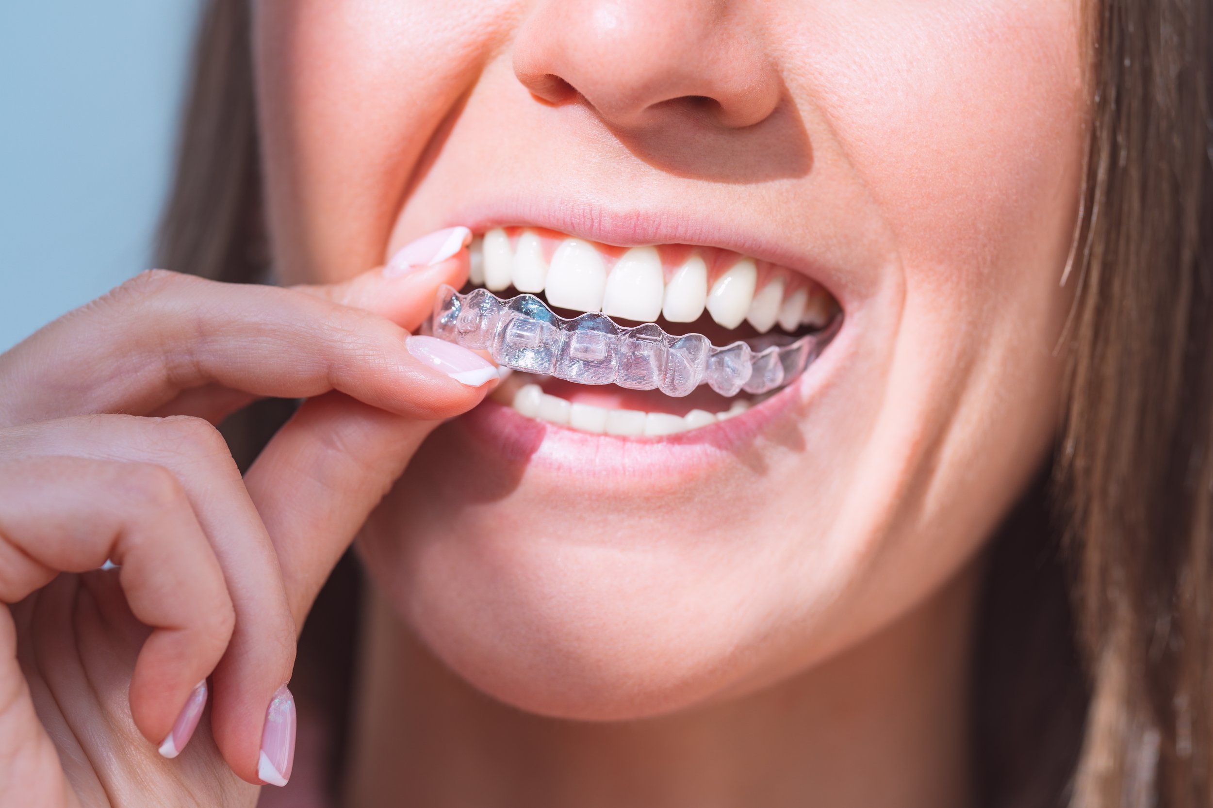 Invisible Braces, Invisalign therapy