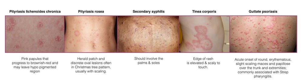 guttate psoriasis herald patch beloderm krém pikkelysömör vélemények