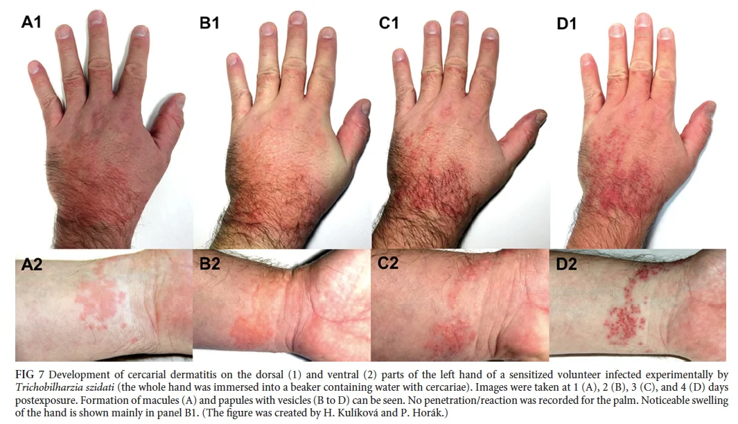 Back from a vacation with beautiful memories and an itchy rash